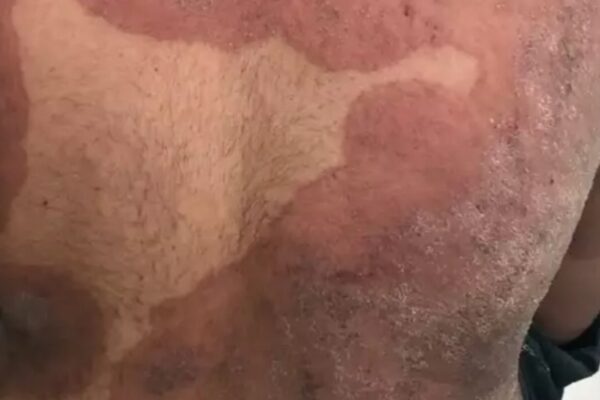 superplesen choroba koza